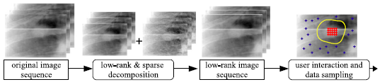 Teaser of A Novel Marker-less Lung Tumor Localization Strategy on Low-rank Fluoroscopic Images with Similarity Learning