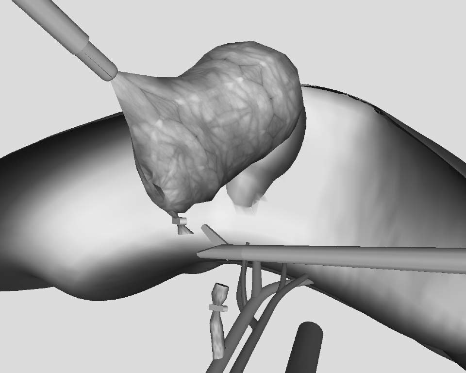 Echtzeitsimulation deformierbarer Objekte zur Ausbildungsunterstützung in der Minimal-Invasiven Chirurgie